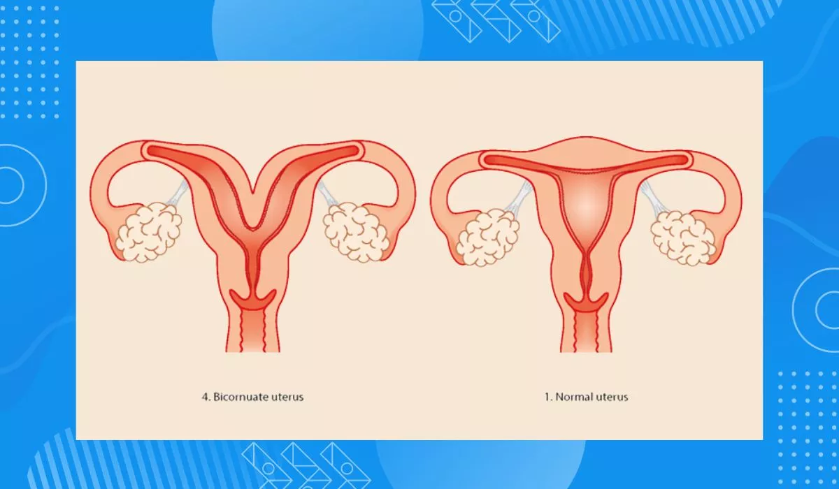 Symptoms Of Bicornuate Uterus