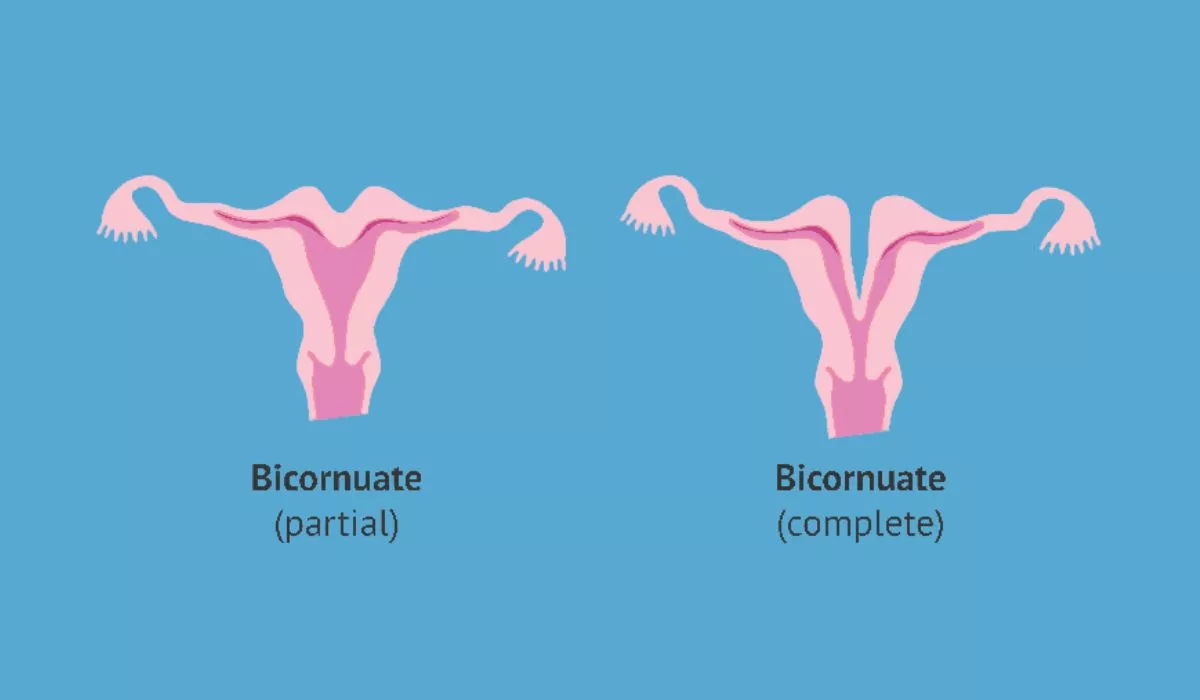 Types Of Bicornuate Uterus